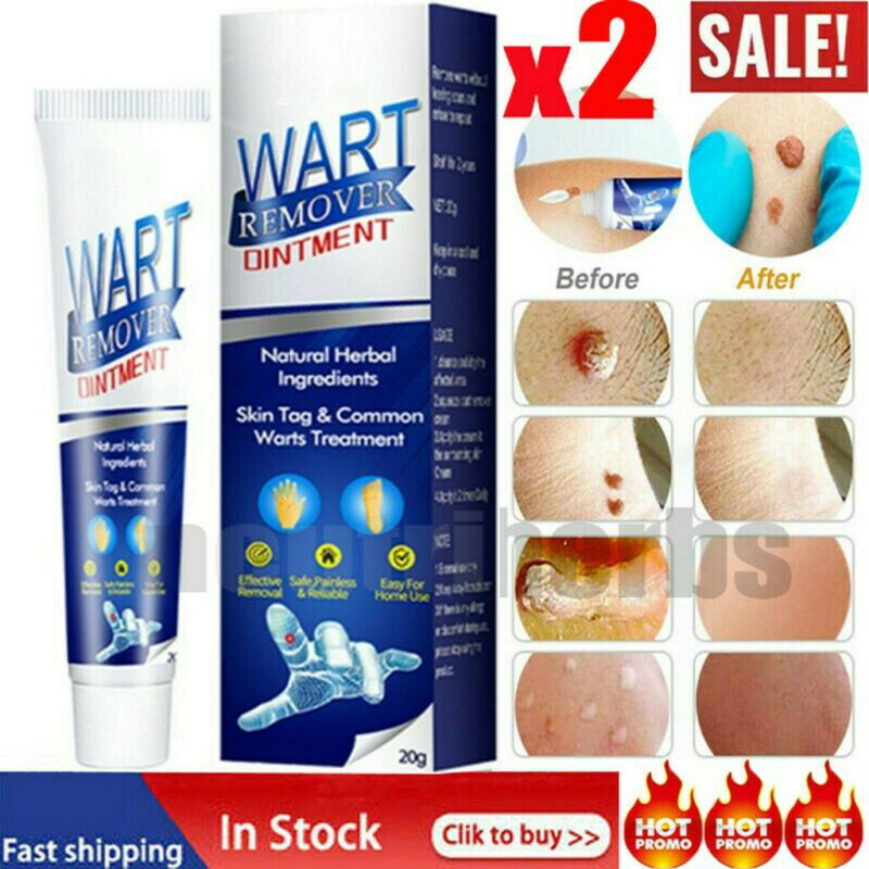 2/1 Wart Skin Tag Remover Cream Antibacterial Extract Corn Plaster Wart Ointment